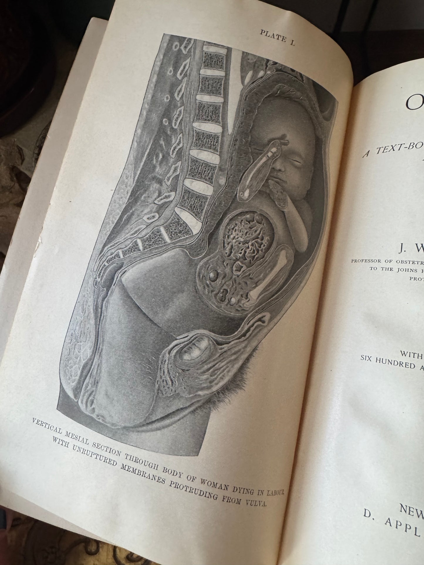 Obstetrics 
A Text-Book for the Use of Students and Practitioners
by J. Whitridge Williams
©️1904